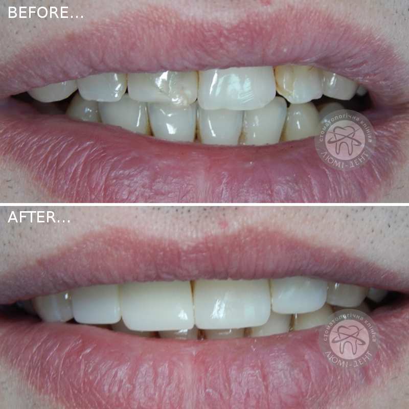 реставрация зубов киев фото люмидент