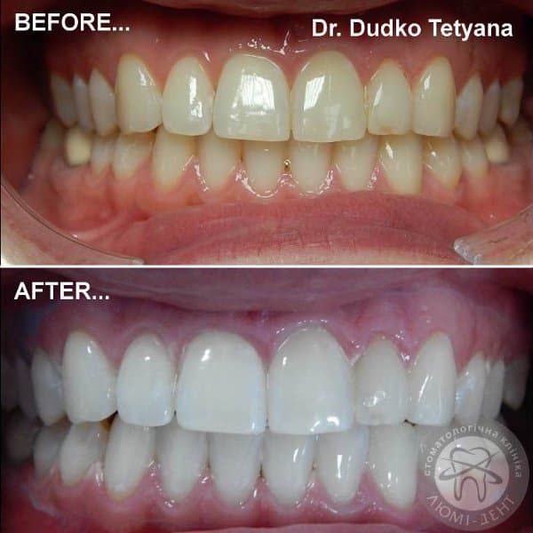 Результат відбілювання в Люмі-Дент Фото Відбілювання Magic Smile Київ Люмі-Дент