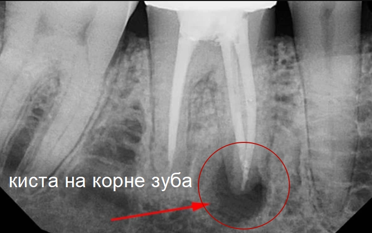 киста зуба фото люмидент