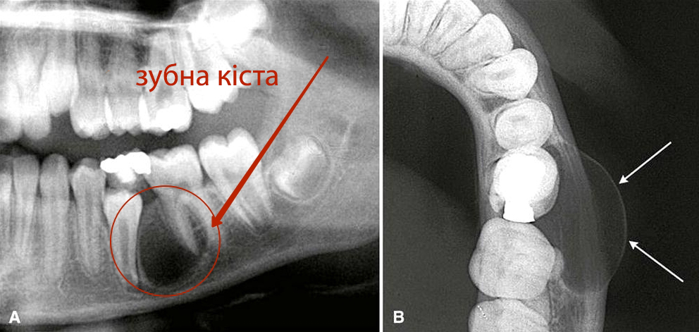 зубна кіста на корені фото люмідент