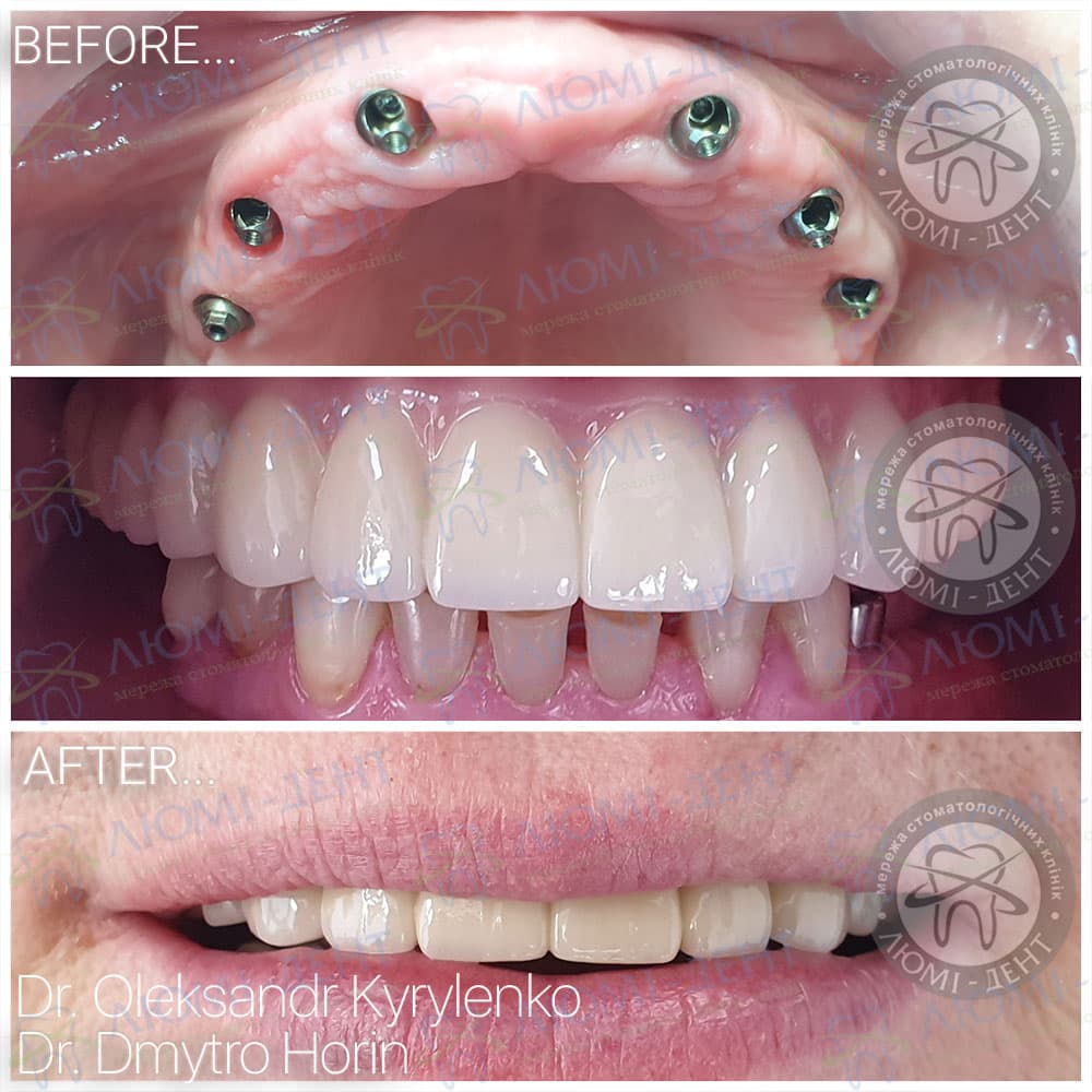 dental prothetics Lumi-Dent