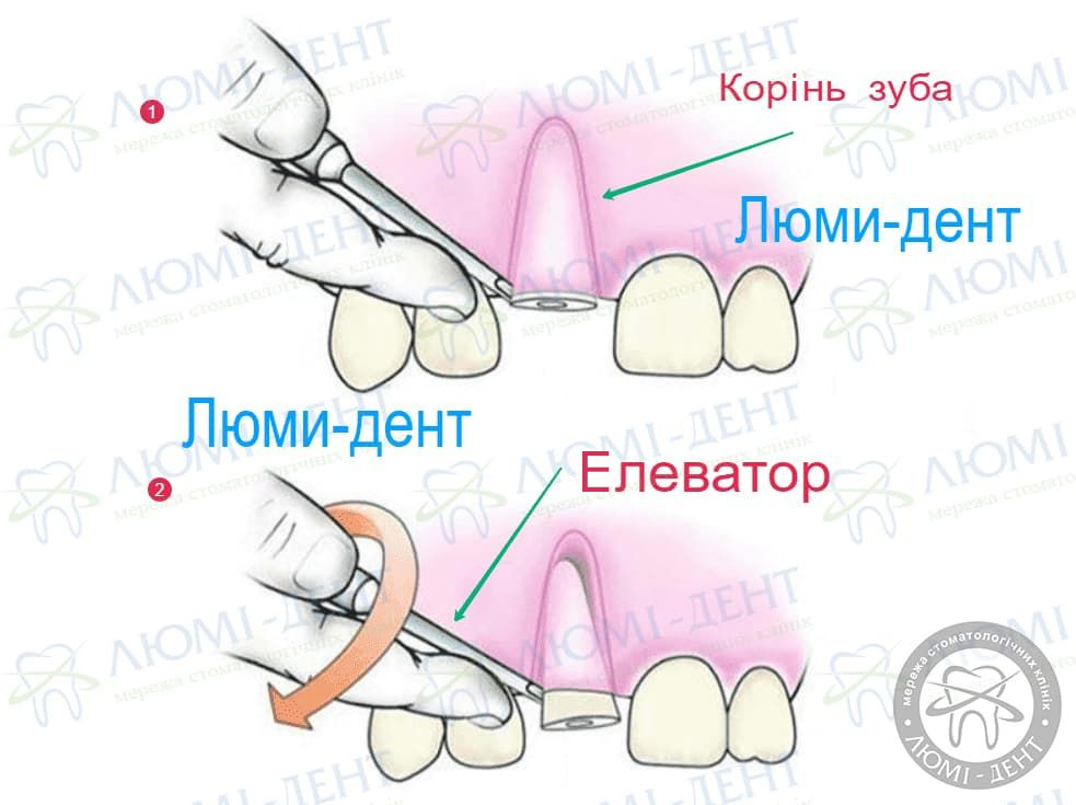 Методи відновлення зубів фото Люмідент