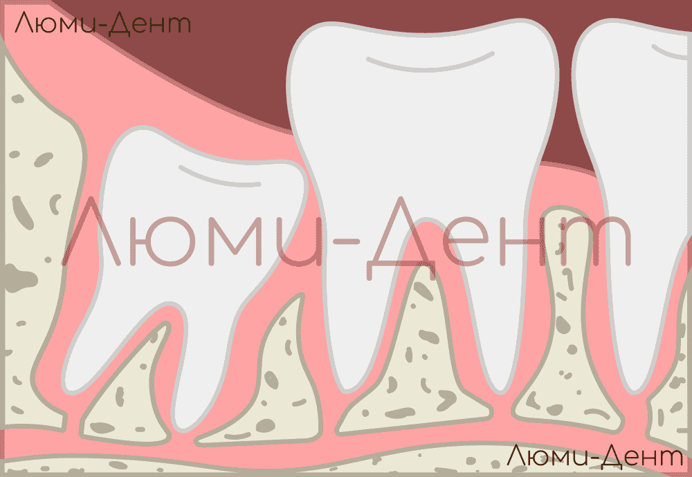 зуб мудрости лезет фото Люми-Дент