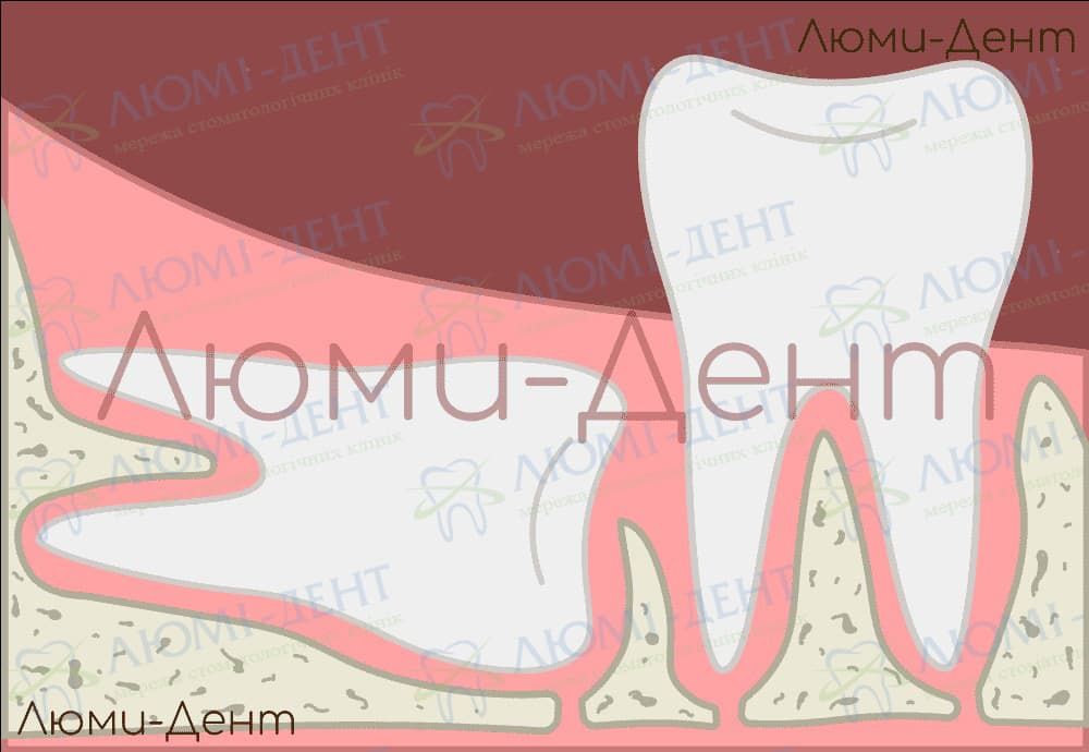 зуб мудрості ріжеться фото Люмі-Дент