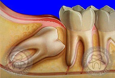 Зуб мудрості прорізується фото Люмі-Дент