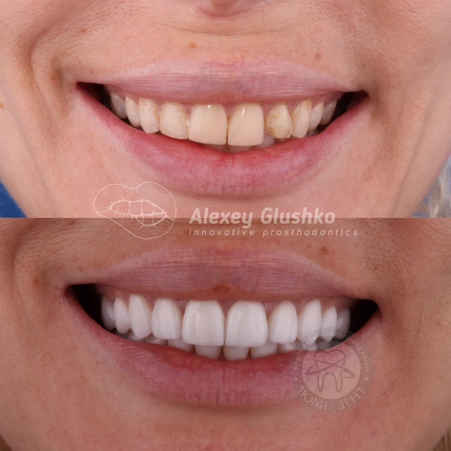 Teeth veneers Veneers Lumi-Dent