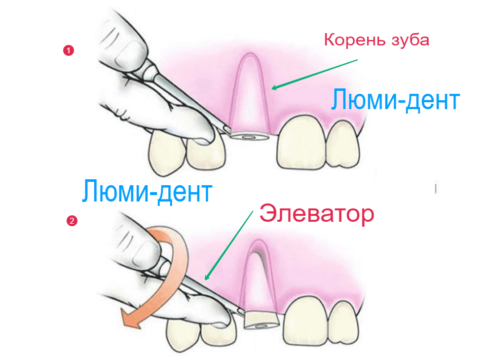 Удаление корня зуба фото Люми-Дент