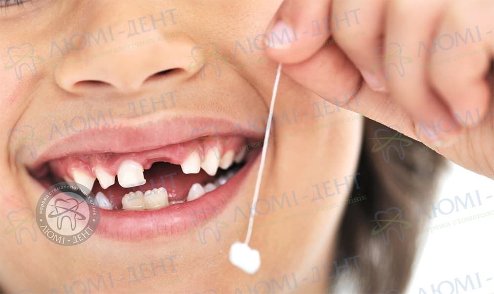 Как правильно вырвать молочный зуб у ребенка