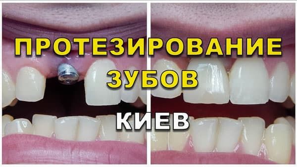 Серебрение молочных зубов Томск Федора Лыткина
