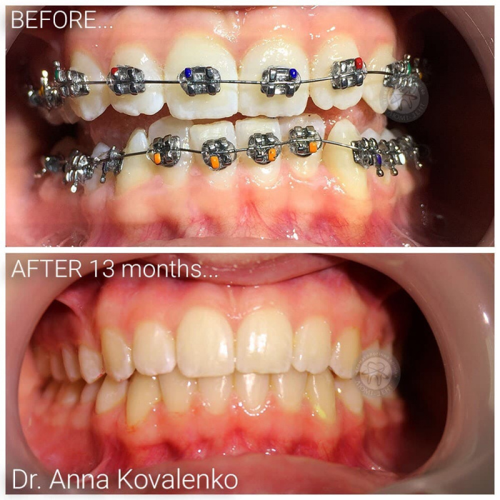 Align the wrong bite with braces Lumi-Dent photo