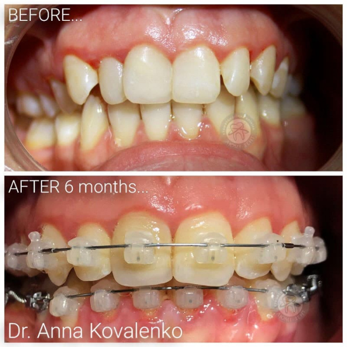 Align the tooth bite for a child photo Kyiv price Lumi-Dent