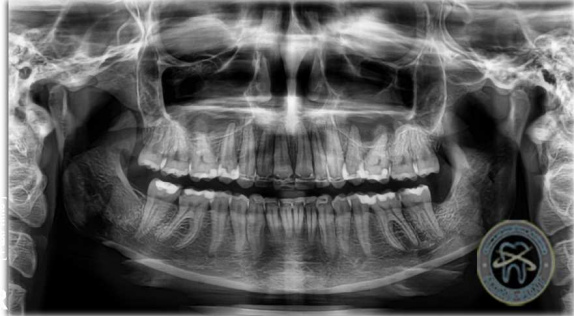 Панорамный рентгеновский снимок челюстей ЛюмиДент 