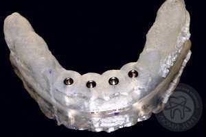 Имплантация зубов видео фото Люмидент