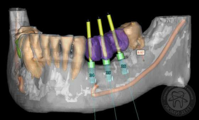 Как ставят импланты зубов видео фото Люмидент