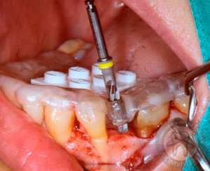 Видео имплантации зубов имплантов фото Люми-Дент