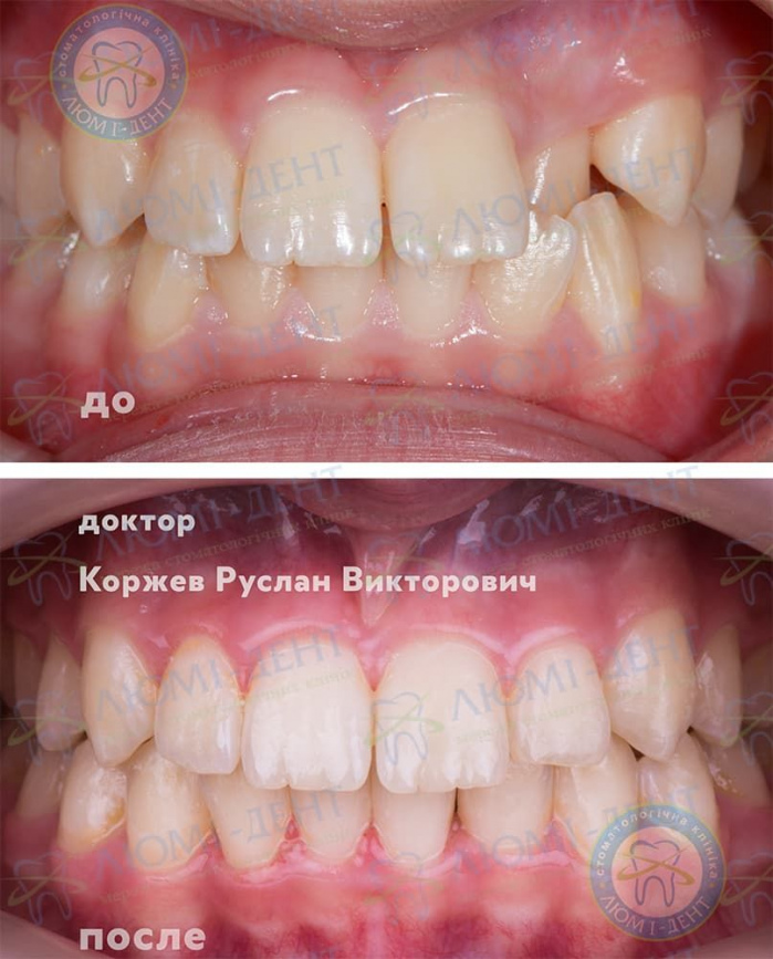 Виправлення неправильного прикусу зубів фото Люмі-Дент