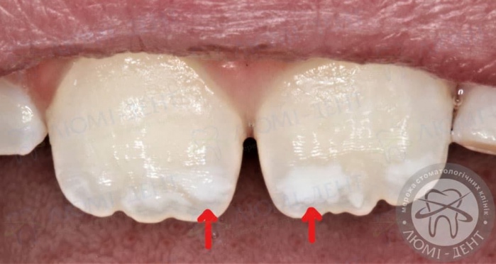 Білі плями на зубах у дитини фото Люмі-Дент