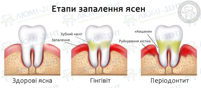 болять ясна при вагітності чим полоскати фото ЛюміДент