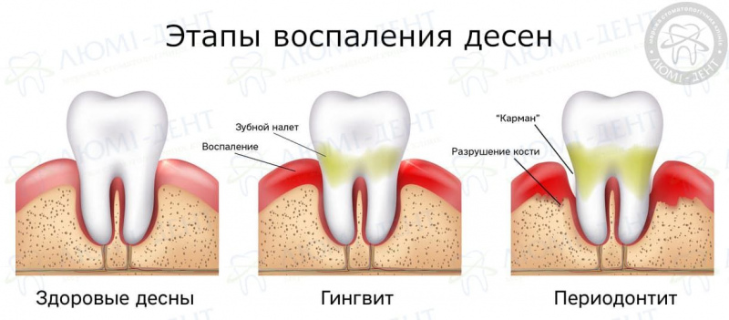 Болят десна при беременности чем полоскать фото Люми-Дент