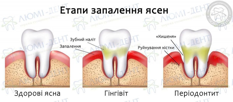  Болять ясна при вагітності чим полоскати фото Люмі-Дент