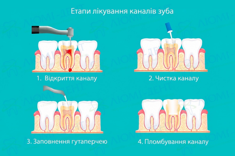Етапи лікування каналів зуба Чи боляче чистити канали зуба фото Люмі-Дент