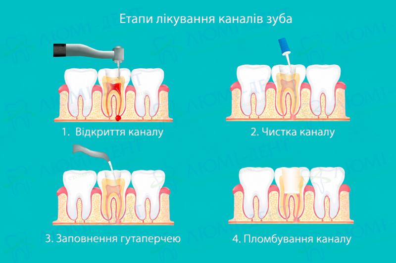 Етапи лікування каналів зуба