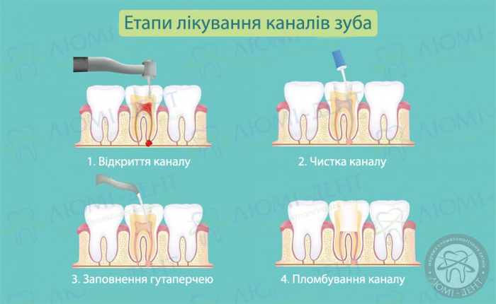 Чистка каналів зуба боляче чи ні фото ЛюміДент