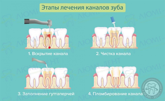 Чистка каналов зуба больно или нет фото ЛюмиДент