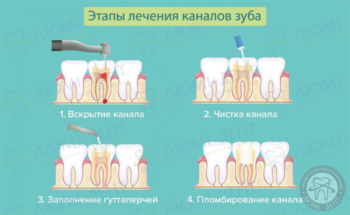 Чистка каналов зуба больно или нет фото Люми-Дент