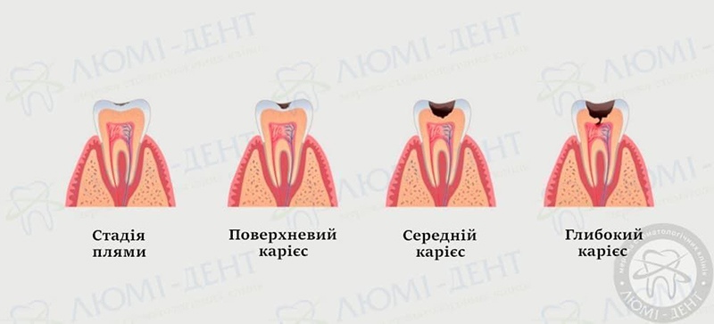 карієс передніх зубів фото Люмі-Дент