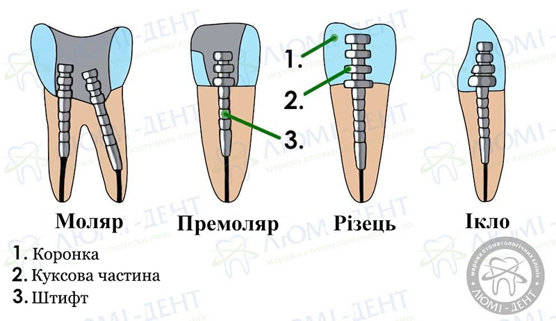 Штифт в зуб боляче фото Люмі-Дент