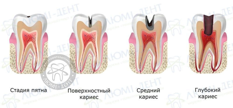 Болить зуб від солодкого фото ЛюміДент