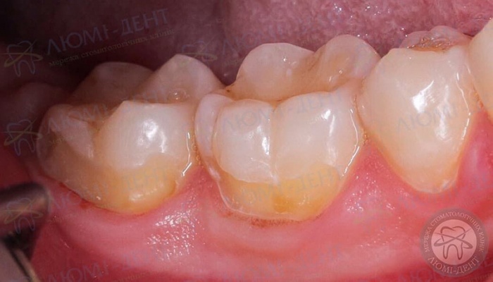 Біль в зубі від солодкого фото Люмі-Дент