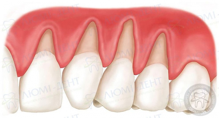 Чому болять зуби від солодкого фото Люмі-Дент