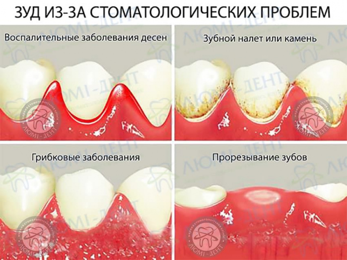 Чешутся десна фото ЛюмиДент