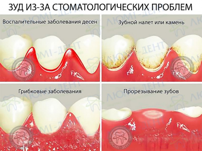 Чешутся десна фото ЛюмиДент