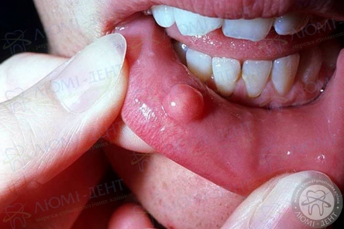 Шишка в роті фото Люмі-Дент