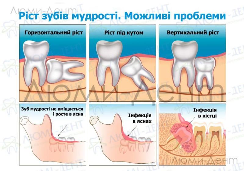 Проблеми росту вісімок Як прорізується зуб мудрості фото Люмі-Дент
