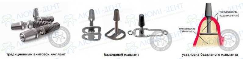 Классические и базальные зубные импланты импланты зубов фото Люми-Дент