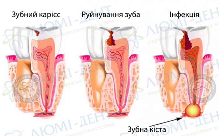 Кіста зуба фото Люмі-Дент