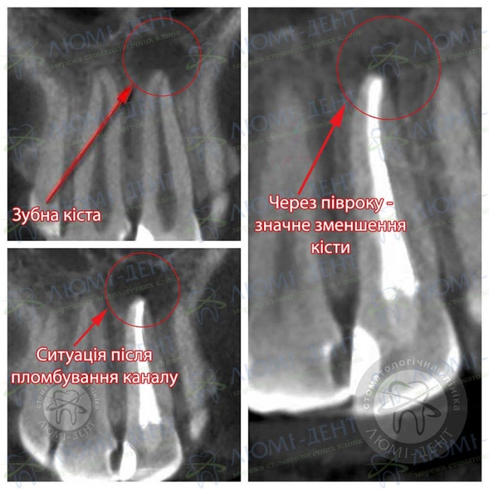 Кіста зуба симптоми фото Люмі-Дент