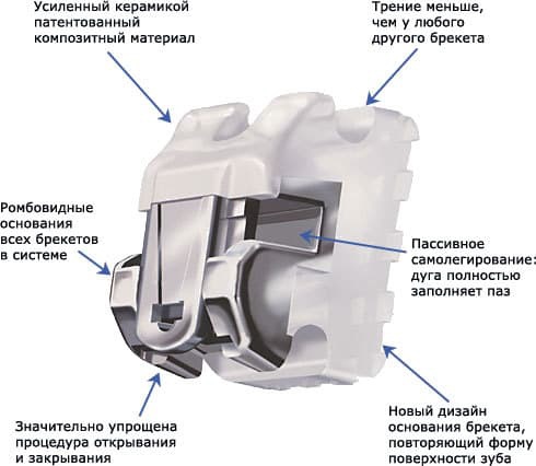 Безлигатурные брекет-системы даймон фото Люми-Дент