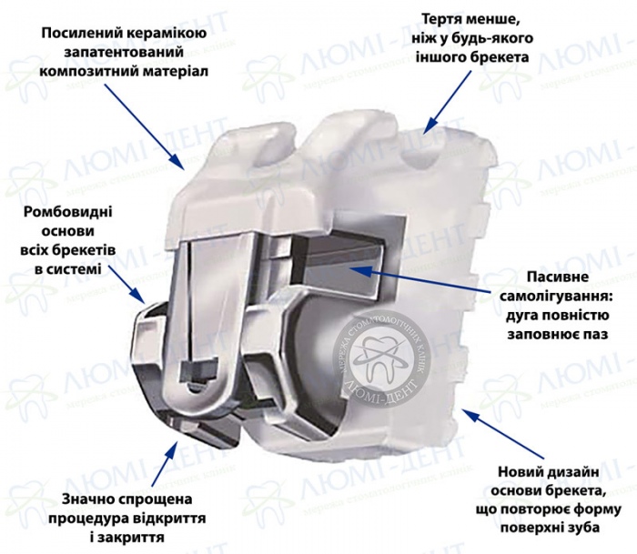 Самолігуючі брекети даймон фото Люмі-Дент