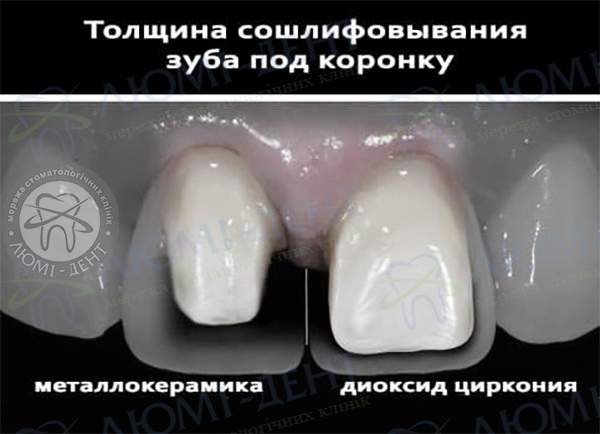 Металлокерамические коронки Киев фото Люми-Дент