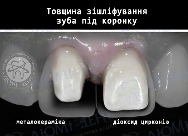 Металокерамічна коронка на зуб Київ фото Люмі-Дент