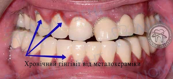 Металокерамічні зуби фото Люмі-Дент