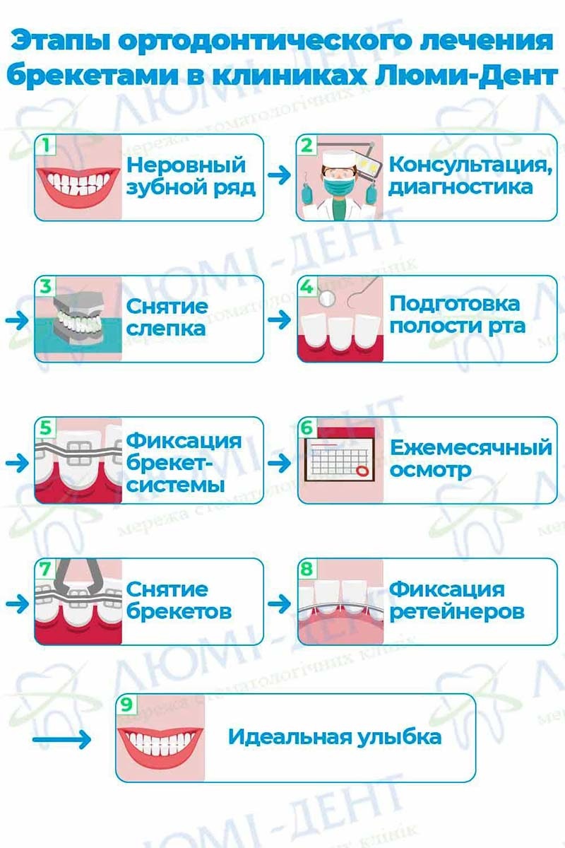 Етапи ортодонтичного лікування брекетами Етапи ортодонтичного лікування брекетами