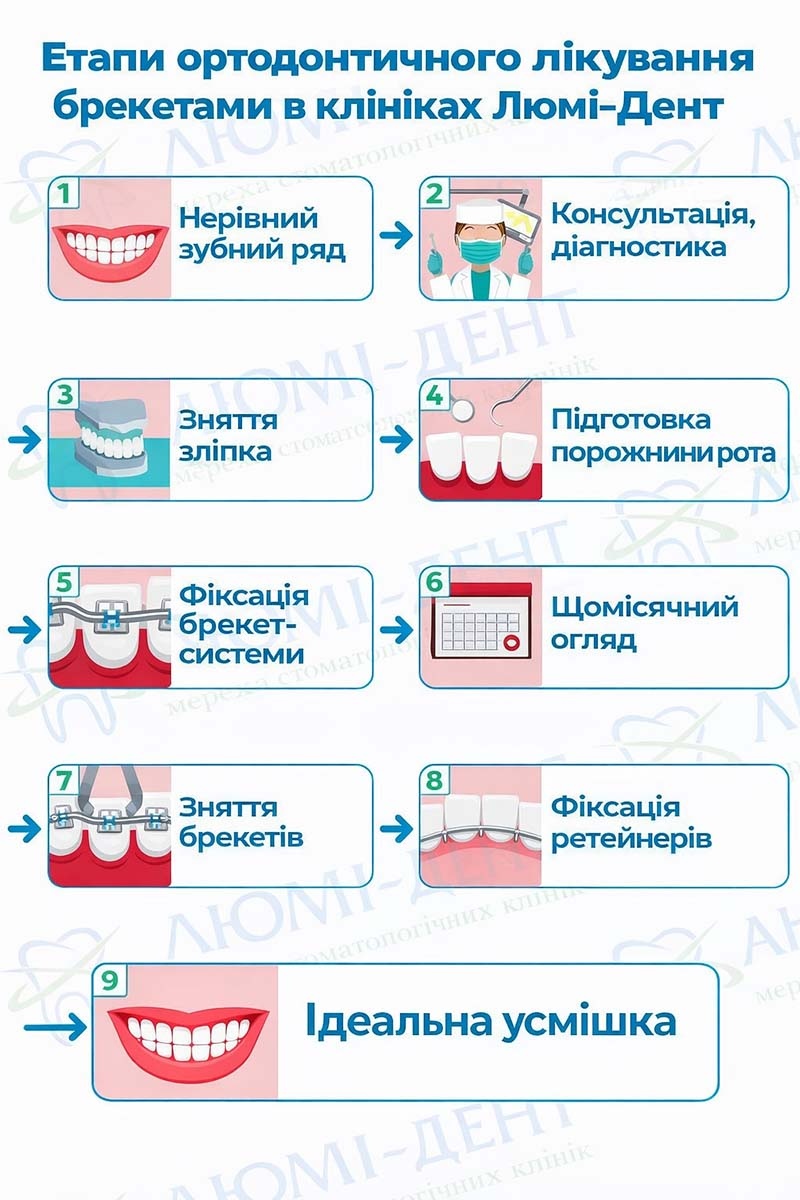 Етапи ортодонтичного лікування брекетами Етапи ортодонтичного лікування брекетами