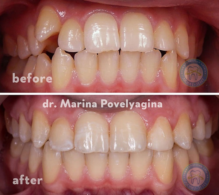 Трейнеры для зубов фото до после Люми-Дент
