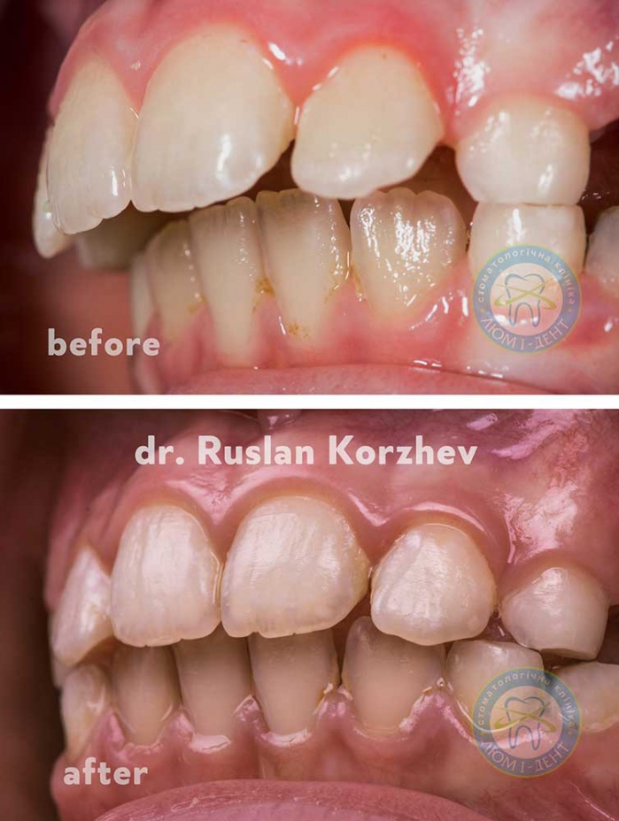 Трейнер для зубів фото до та після Люмі-Дент